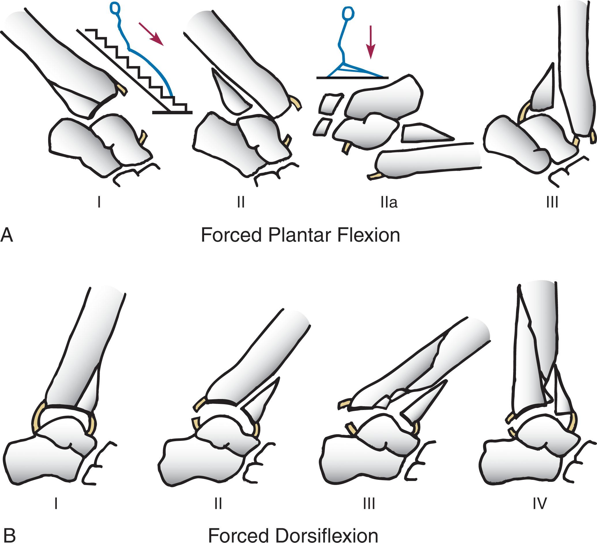 Fig. 43-5, Mechanism of injury according to Böhler is a combination of axial load plus the position of the foot at the time of impact. A , Injuries with plantar flexion. B , Injuries with dorsiflexion.