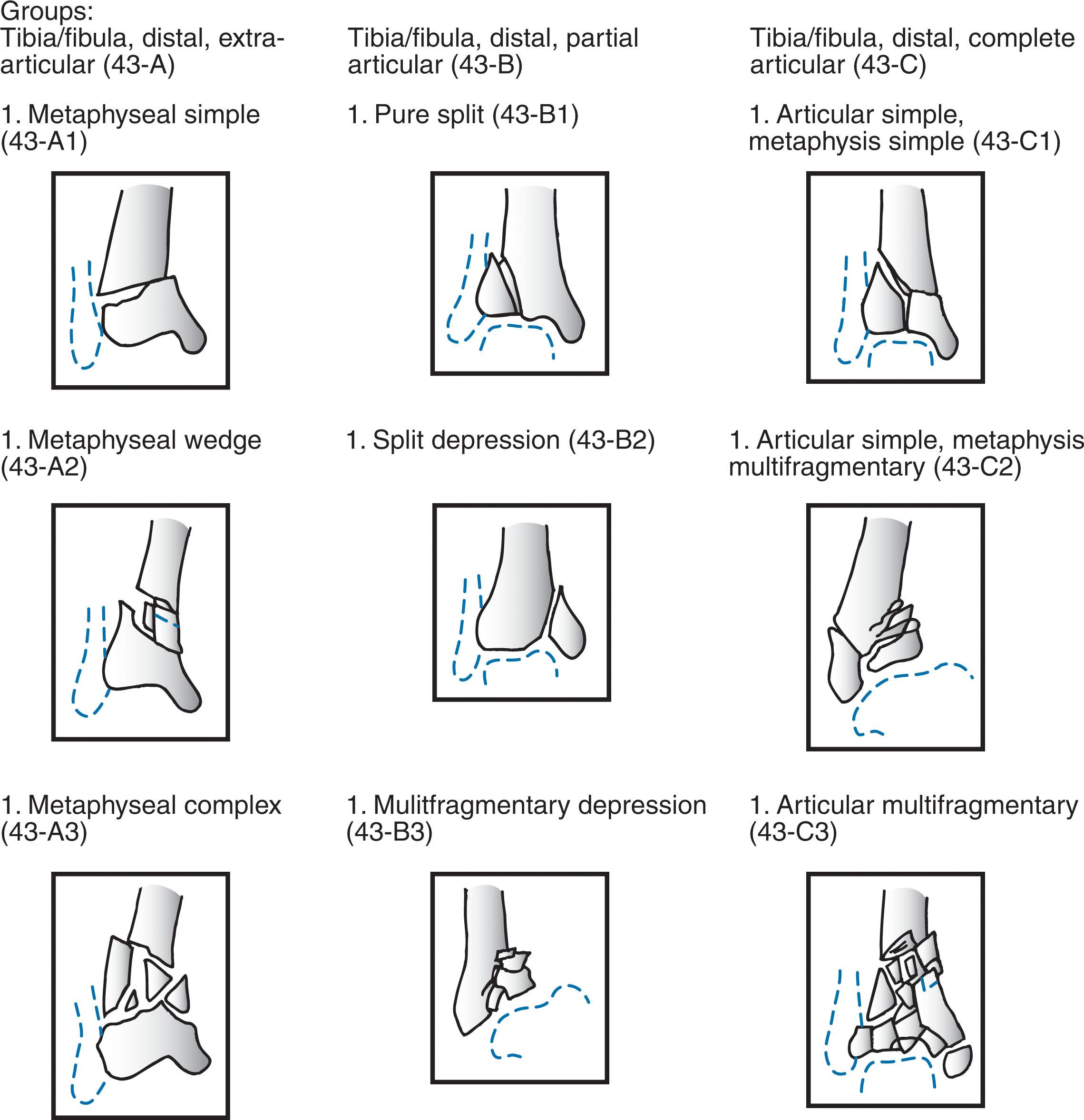 Fig. 43-6, Orthopaedic Trauma Association classification of pilon fractures, groups 43-A to 43- C.