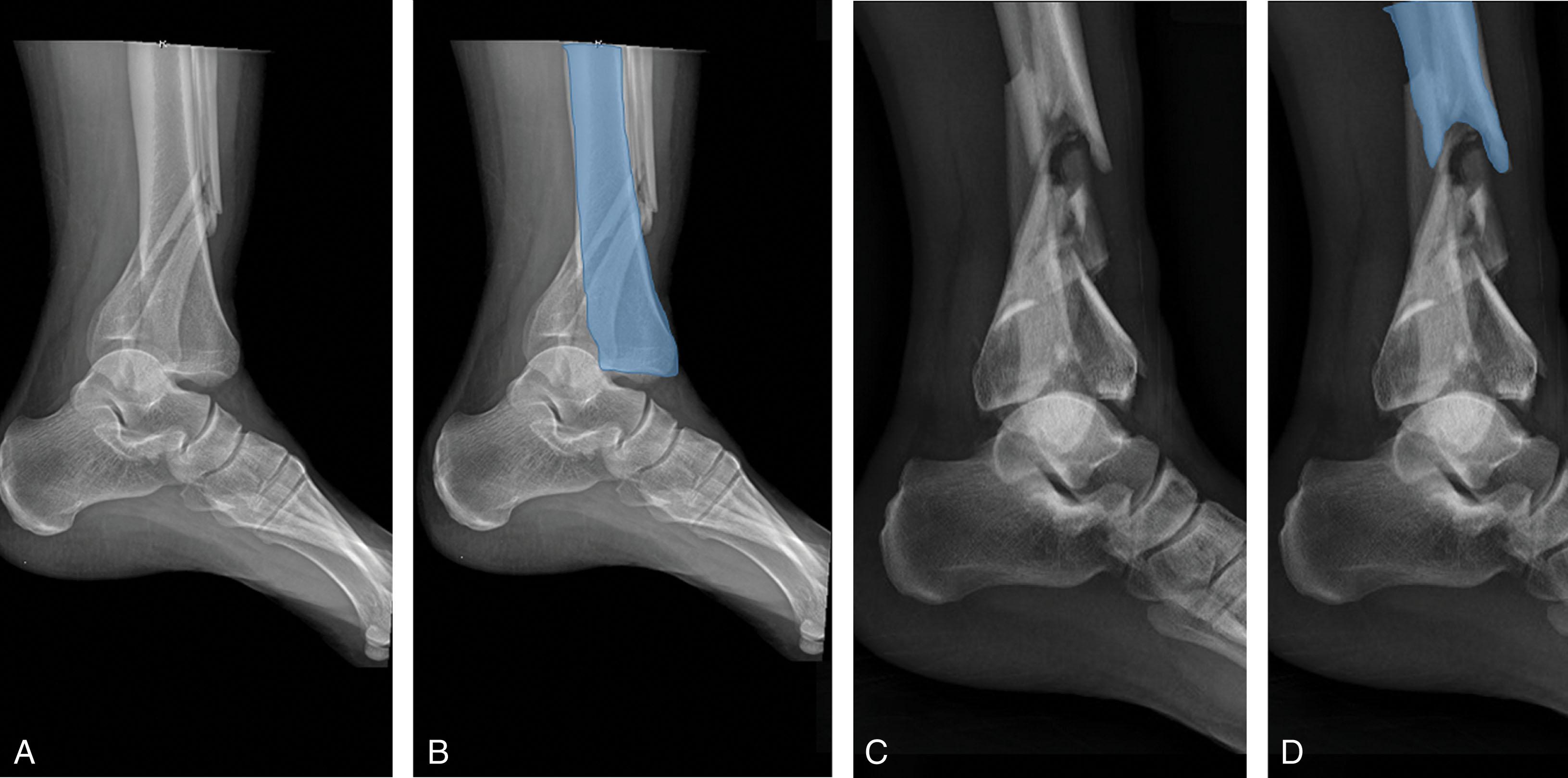 Fig. 43-7, A , Lateral radiograph demonstrating an Orthopaedic Trauma Association (OTA) type B partial articular fracture. B , The shaded portion of the radiograph demonstrates continuity between the tibial diaphysis and distal tibial articular surface. C , A lateral radiograph demonstrating an AO\OTA type C complete articular fracture. D , The shaded portion of the C-type fracture shows the articular fragments have no connection to the tibial shaft.