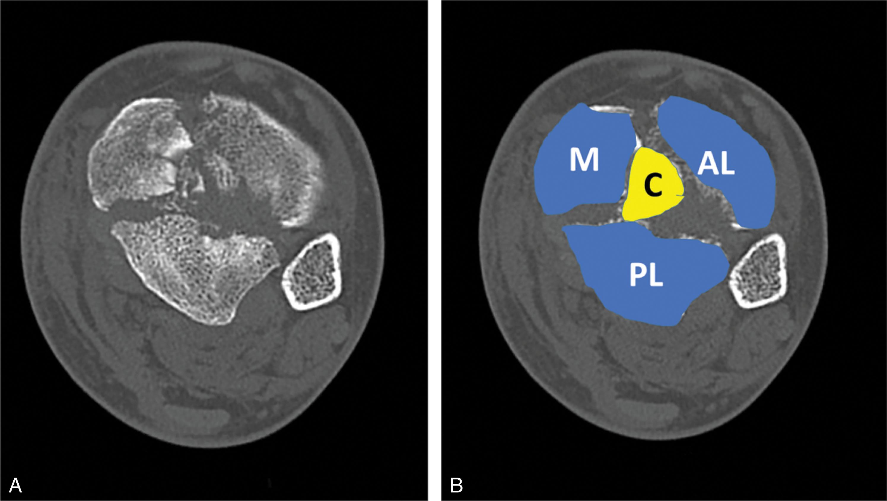 Fig. 43-8, A , The axial computed tomography (CT) scan at the level of the articular surface demonstrates the major fragments that are typical of tibial plafond fractures. B , The major fracture fragments are highlighted including the anterolateral (AL) Chaput fragment, posterolateral (PL) Volkmann fragment, and medial malleolar (M) fragment. Commonly there is central impaction (C) that must be addressed and can be accessed through the anterior fracture line.