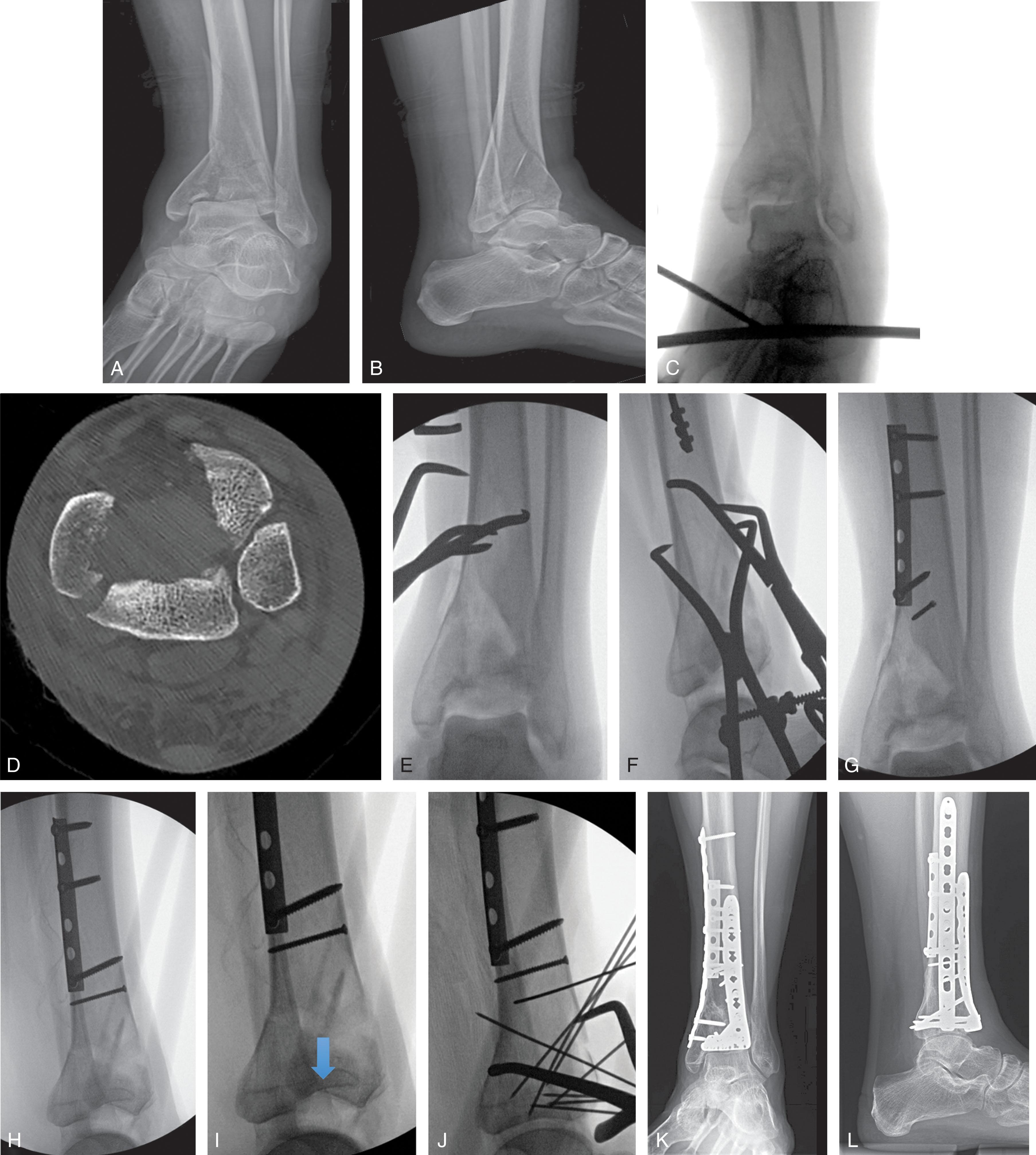 Fig. 43-9, A and B , Radiographs of an OTA 43-C type pilon fracture with long metaphyseal extension. C and D , Radiograph and axial computed tomography (CT) scan after spanning external fixation restoring length and overall alignment demonstrating articular surface displacement. E and F , Intraoperative fluoroscopy views show reduction of the large posterolateral fragment, converting the C-type fracture to a B-type. G and H , Intraoperative fluoroscopy after internal fixation of the posterior articular fragment to the tibial shaft, converting the C-type fracture to a B-type. I and J , Intraoperative fluoroscopy of secondary procedure to fix the remainder of the articular surface, taking advantage of the previously fixed posterior articular fragment. The blue arrow demonstrates persistent joint depression prior to reduction. K and L , Final radiographs after two stage open reduction internal fixation using the C- to B-type conversion strategy.