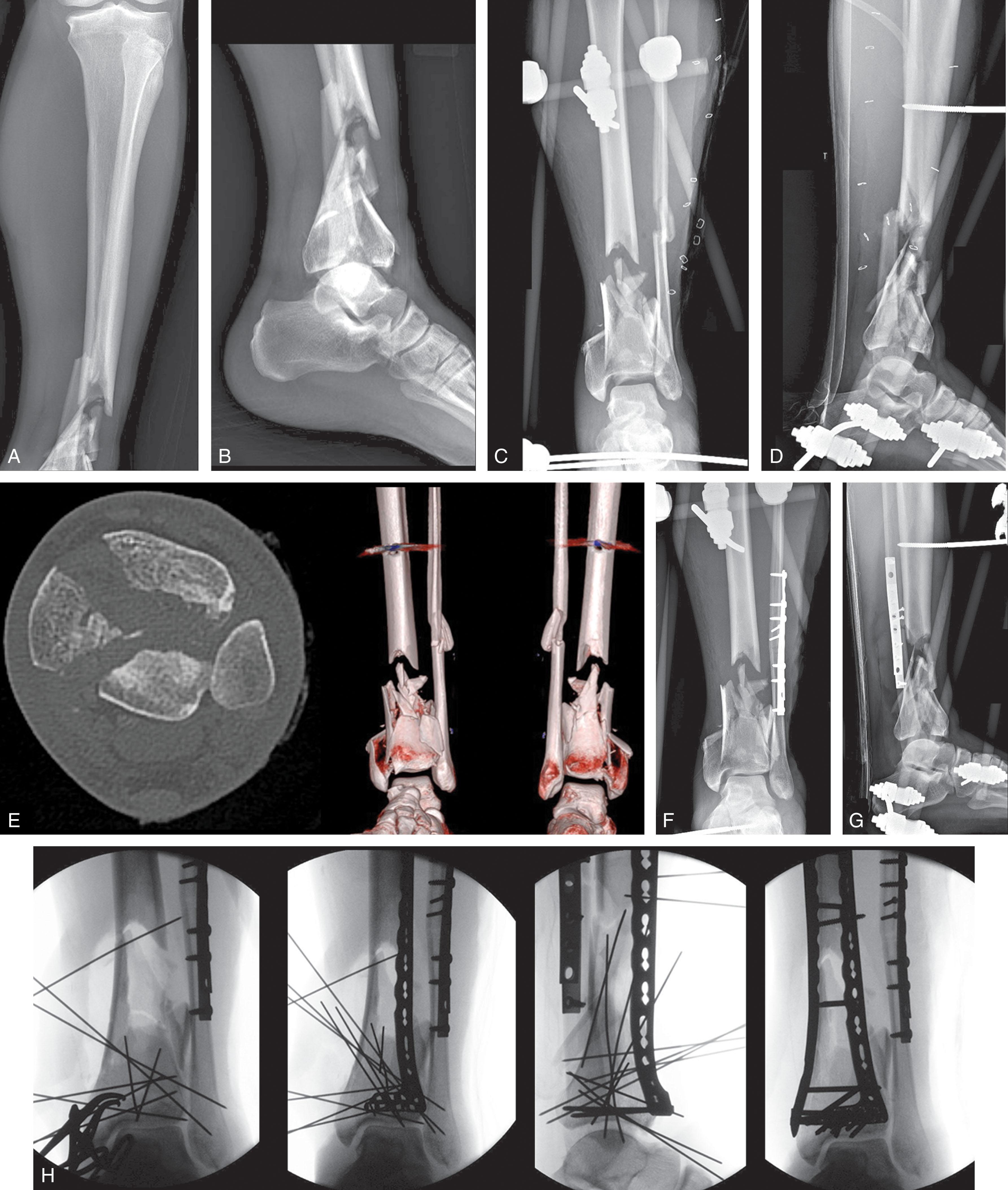 Fig. 43-10, A and B , Radiographs of a C-type open pilon fracture with severe metaphyseal comminution. C and D , Radiographs after stage 1 treatment with external fixation and fasciotomy due to elevated compartment pressures. E , Computed tomography (CT) scans after length has been restored with the external fixator. F and G , Radiographs of stage 2 fibular fixation and skin grafting of the lateral fasciotomy. Note that length was difficult to judge in stage 1 due to comminution of both the fibula and tibia. After, fibular fixation length can be assessed more easily. H , Intraoperative fluoroscopic views of stage 3, consisting of definitive ORIF using an anteromedial approach due to the medial exit of the anterior fracture line. The reduction strategy is a “C to A conversion” with reduction of the articular block first from posterior to anterior followed by reduction of the articular block to the shaft using a fragment of medial metaphyseal cortex. I and J , Due to the extensive comminution and open fracture, antibiotic beads were placed, and bone grafting was performed 6 weeks later. K and L , Radiographs at 2 years after medial plate removal due to symptomatic hardware.