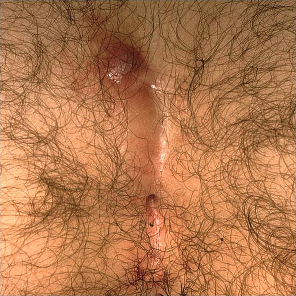 FIGURE 153.1, Sacrococcygeal pilonidal abscess and midline pit.