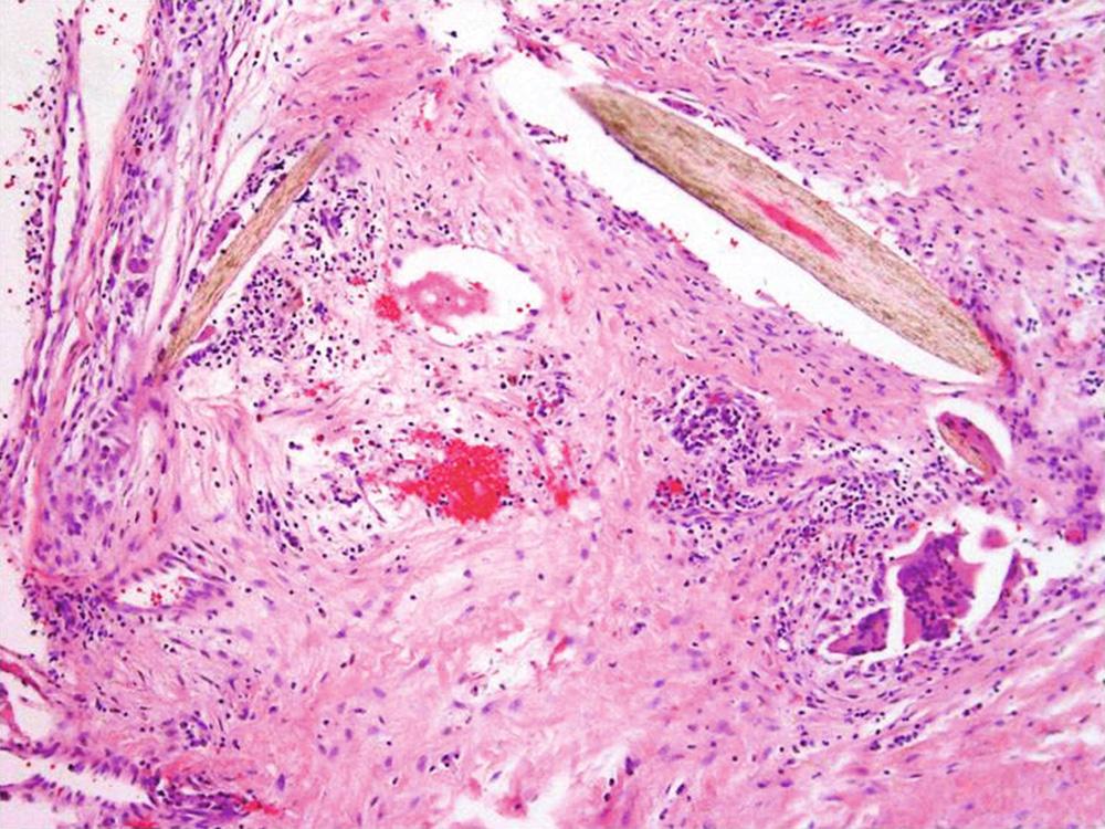 FIGURE 153.2, Histopathology: hair follicle with foreign-body giant cell reaction in a pilonidal cyst.