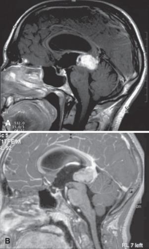 Fig. 11.1, Magnetic resonance imaging aspects of pineal parenchymal tumors (T1-weighted images with gadolinium contrast enhancement). Radiologic findings do not usually permit a reliable prediction of histopathologic type. (A) Pleomorphic pineocytoma. Lobulated mass of the pineal region with strong and relatively homogeneous contrast enhancement. (B) Pineoblastoma. Irregular and lobulated tumor exhibiting mild, heterogeneous contrast enhancement.