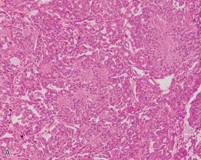 Fig. 11.2, Typical and pleomorphic pineocytomas. (A) Histologic appearance of a typical pineocytoma. Well-differentiated tumor composed of uniform cells with round nuclei. Large and irregular pineocytomatous rosettes are distinctive. (B) Histologic appearance of a pineocytomatous rosette. The rosette is composed of interwoven fibrillary processes with bulbous endings. (C) Synaptophysin immunolabeling in a typical pineocytoma. Synaptophysin immunolabeling is strong, especially in pineocytomatous rosettes. (D) Neurofilament protein expression in a typical pineocytoma. Reactivity is strong, especially in pineocytomatous rosettes. (E) Neurofilament protein expression in a pineocytomatous rosette. Numerous bulbous endings, typical of pineal differentiation, may be observed in the center of the rosette. (F) Histologic appearance of a pleomorphic pineocytoma. In this variant, nuclei are focally large, atypical, and hyperchromatic. This may be misinterpreted as indicative of malignancy.