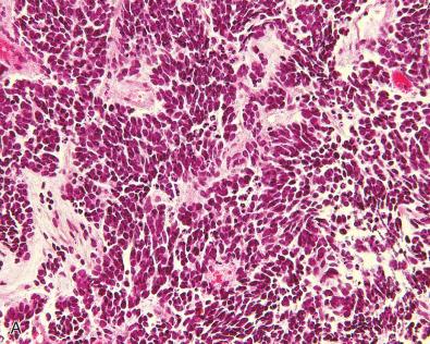 Fig. 11.3, Pineoblastoma. (A) Histologic appearance of a pineoblastoma. Tumor with dense cellularity and carrot-shaped hyperchromatic nuclei. (B) Histologic appearance of a pineoblastoma. Neoplastic cells have a high nuclear-to-cytoplasmic ratio and scant cytoplasm. Nuclei are densely packed. Mitoses and apoptotic bodies are readily seen. (C) Diffuse synaptophysin expression in a pineoblastoma. Other neuronal markers such as neurofilament protein are inconsistently expressed. (D) MIB-1 proliferation index in a pineoblastoma. The proliferation index in this case is about 40% in the most proliferative areas. (E) INI1 expression in a pineoblastoma. INI1 nuclear expression is retained allowing the distinction from the small blue cell component of atypical teratoid/rhabdoid tumor. (F) Lack of LIN28A expression in a pineoblastoma. Unlike embryonal tumors with multilayered rosettes, there is no significant LIN28A expression in pineoblastomas.