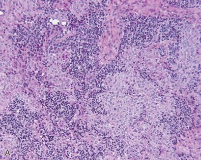 Fig. 11.4, Pineoblastoma invading normal pineal gland. (A) Sheets of poorly differentiated cells mixed with areas of normal pineocytes. This may be misinterpreted as a mixed pineocytoma/pineoblastoma. (B) Neoplastic cells are small with scant cytoplasm. Their nuclei are atypical, round, elongated, or angular, with a dense chromatin. Normal pineocytes have a round to oval nucleus with a thin chromatin and an inconspicuous nucleolus. Their cytoplasm is clear within a fibrillar background. (C) Neurofilament expression is strong in the normal pineal gland. (D) Ki-67 proliferation index is high in the pineoblastoma component in contrast with the normal pineal gland where no positive nuclei are seen.