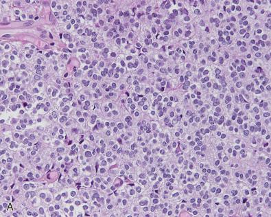 Fig. 11.5, Pineal parenchymal tumors of intermediate differentiation. (A) Histologic appearance of a low-grade PPTID. In this case, tumoral architecture is diffuse. This tumor exhibits a neurocytoma- or oligodendroglioma-like appearance. Nuclei are relatively uniform with slight anisokaryosis. The neoplastic cells show a clear perinuclear halo. The fibrillar background is scant without large pineocytomatous rosettes. (B) Histologic appearance of a high-grade PPTID. The architecture is pseudolobulated, with vessels delineating vague lobules. (C) Nuclei are round, with dense chromatin and small but prominent nucleoli. A mitosis is also seen. (D) Neurofilament protein expression in a high-grade PPTID. Focal clusters of cells are positive. (E) Ki-67-immunolabeling index in a low-grade PPTID. Proliferation index is low, about 2% in this case. (F) Ki-67-immunolabeling index in a high-grade PPTID. Proliferation index is high, about 15% in this case.