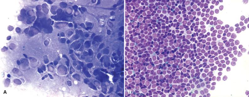 Fig. 11.6, Pitfalls in cytologic specimens. (A) Cytologic preparation of a pleomorphic pineocytoma (May, Grunwald, Giemsa [MGG]). In intraoperative diagnosis, marked nuclear atypia may be misinterpreted as indicative of malignancy. (B) Cytologic print of a high-grade PPTID (MGG). Higher-grade tumors show a more uniform nuclear appearance.