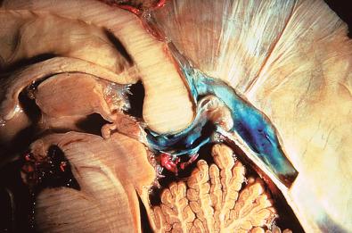 Figure 42.1, Midline sagittal section through the pineal region and related structures in a fixed human cadaver, vessels injected in red (arteries) and blue (veins).