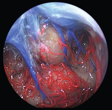 Figure 42.2, Endoscopic view using a supracerebellar infratentorial approach demonstrating the pineal gland and the collicular plate. Note the variability of the vascularization; veins injected in blue, arteries in red in a nonfixed human cadaver.