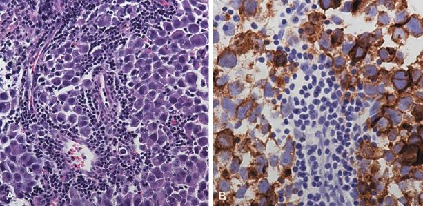 Figure 42.5, Histopathologic features of a germinoma with typical lymphocytic infiltrates along fibrovascular septae (H&E, ×200) (A) and immunohistochemistry staining of the cytoplasm and cytoplasmic membrane with placental alkaline phosphatase (PLAP) (×400) (B).