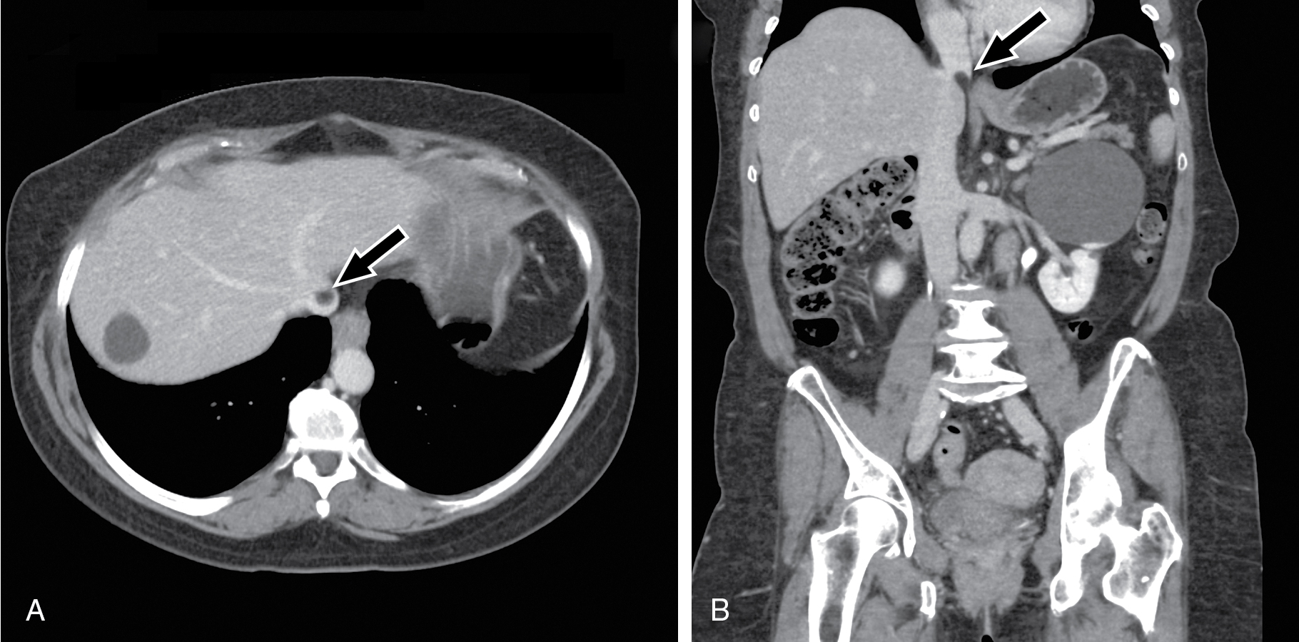 Fig. 39.1, Inferior vena cava pseudolipoma. A, Axial contrast enhanced abdominopelvic computed tomography image shows a fat attenuation filling defect ( arrow ) in the inferior vena cava at the diaphragm. This finding should not be mistaken for nonocclusive thrombus or a fat containing mass, such as lipoma. B, The coronal reformatted image shows that the lesion ( arrow ) is retroperitoneal fat protruding into the vessel, a benign finding.