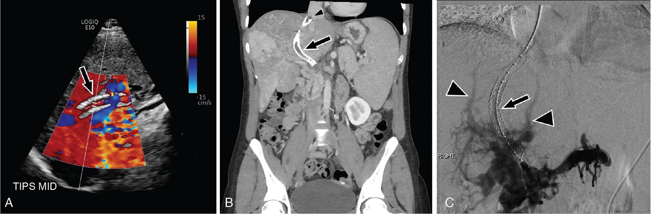 Fig. 39.2, Transjugular intrahepatic portosystemic shunt ( TIPS ) thrombosis. A, B-mode and color Doppler ultrasound image showing TIPS stent ( arrow ) with apparent internal color flow. Diffuse background color signal should raise concern that this flow is artifactual. B, Contrast enhanced computed tomography shows absent enhancement within the TIPS stent ( arrow ) and extension of thrombus into the inferior vena cava ( small arrowhead ). C, Digital subtraction angiogram confirms TIPS occlusion ( arrow ) and collateral vessel ( arrowheads ) formation.