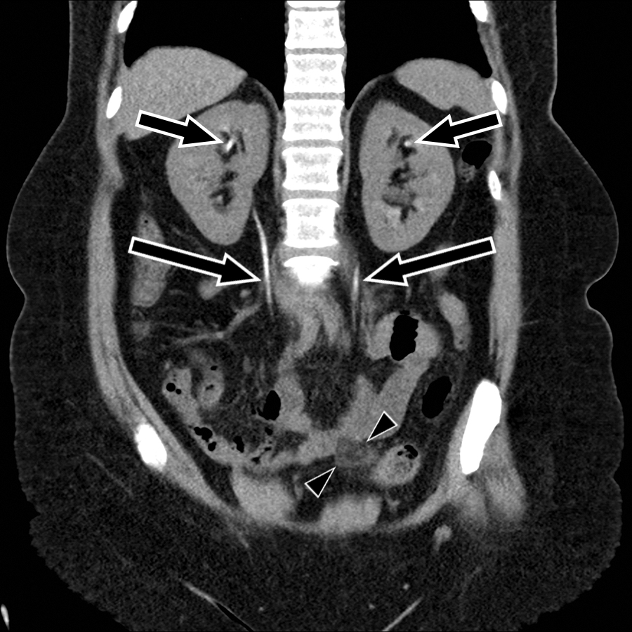 Fig. 39.3, Excreted contrast mimicking renal stones. A 48-year-old woman with left flank pain underwent noncontrast computed tomography (CT) to assess for nephrolithiasis. Coronal reformation shows scattered hyperdensities in the bilateral upper renal poles ( arrows ), which should be recognized as excreted contrast material as the ureters ( long arrows ) are completely opacified. Search of the medical record confirmed that the patient underwent gadolinium enhanced breast magnetic resonance imaging 30 minutes before the CT. Excreted gadolinium, like iodine, is hyperdense. Epiploic appendagitis ( arrowheads ) was identified as the likely source of pain.