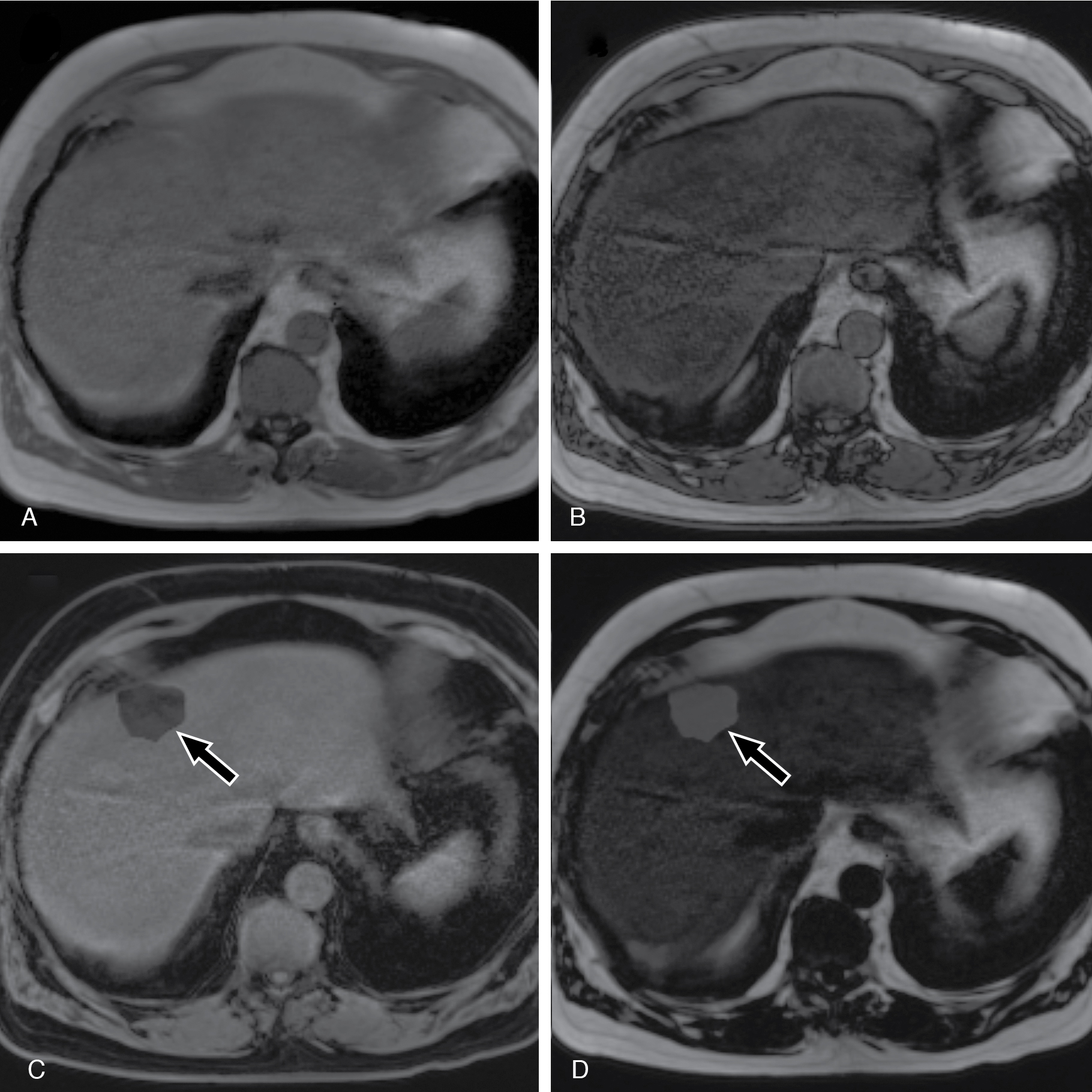 Fig. 39.4, Dixon pixel swap. Axial in phase (A) and out of phase (B) magnetic resonance imaging sequences show background hepatic steatosis without focal lesion. The corresponding water only (C) and fat only (D) images show a focal lesion ( arrows ). The matching abnormality on the water and fat images, in the absence of any lesion on in-phase or out-of-phase images, and sharp/jagged/nonanatomic lesion boundaries are all typical of pixel swap artifact in which the fat and water pixels are mapped to the wrong image set. No lesion was seen throughout the rest of the examination in this location.