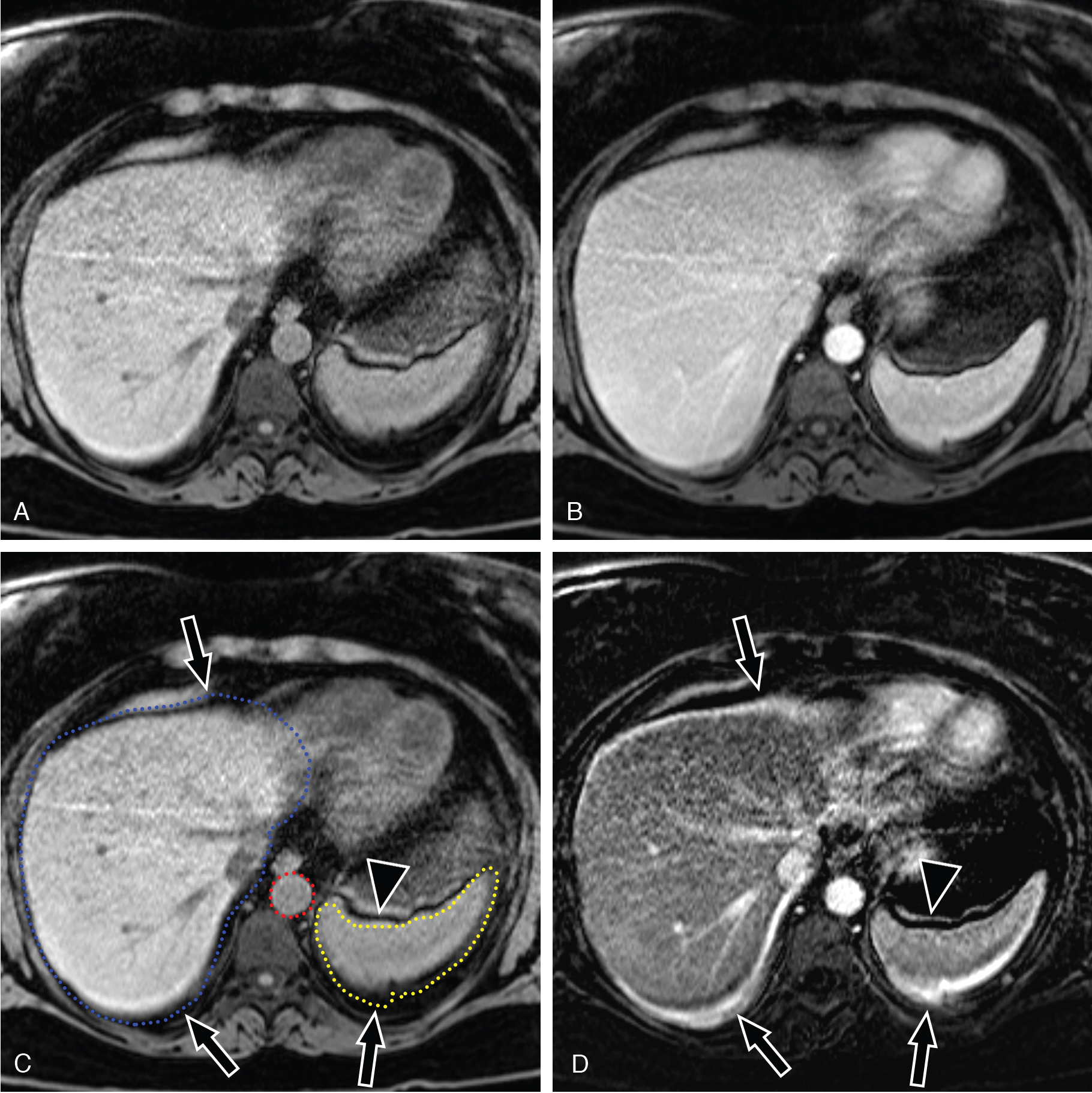 Fig. 39.5, Subtraction artifact. (A) Precontrast and (B) postcontrast axial magnetic resonance imaging (MRI) images are obtained as a part of a standard MRI protocol. (C) The contrast enhanced liver ( blue outline ) is slightly larger ( arrow ) than the precontrast liver ( background ) because of respiratory motion. The postcontrast spleen ( yellow outline ) has moved slightly posteriorly ( arrowhead ). The aorta ( red outline ) was stationary. (D) The subtraction image has a hyperintense rim around the liver ( arrow ), hypointense band anterior to the spleen ( arrowhead ) and hyperintense band posterior to the spleen because of misregistration.