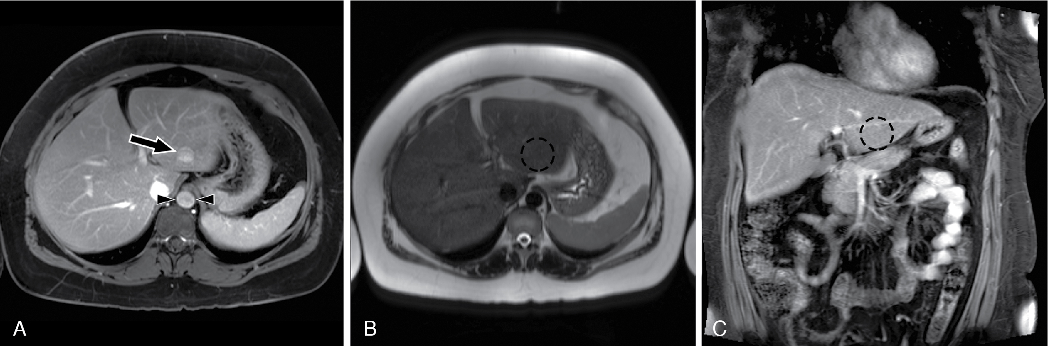 Fig. 39.6 Aortic pulsation artifact., (A) Axial postcontrast magnetic resonance imaging image shows an apparent focal liver lesion in segment 2/3 ( arrow ). Careful inspection reveals the lesion to be the same shape and directly anterior to the aorta ( arrowheads ), consistent with a ghost artifact from aortic pulsation. This lesion is not present on an (B) axial T2-weighted image or a (C) coronal postcontrast image.