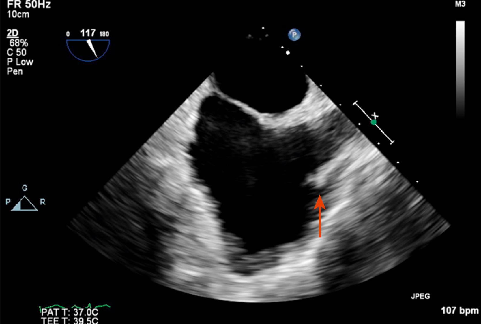 Figure 15.1, Midesophageal 117-degree view of a crista terminalis (red arrow) mimicking a right atrial mass. (Also see Video 15.1 .)