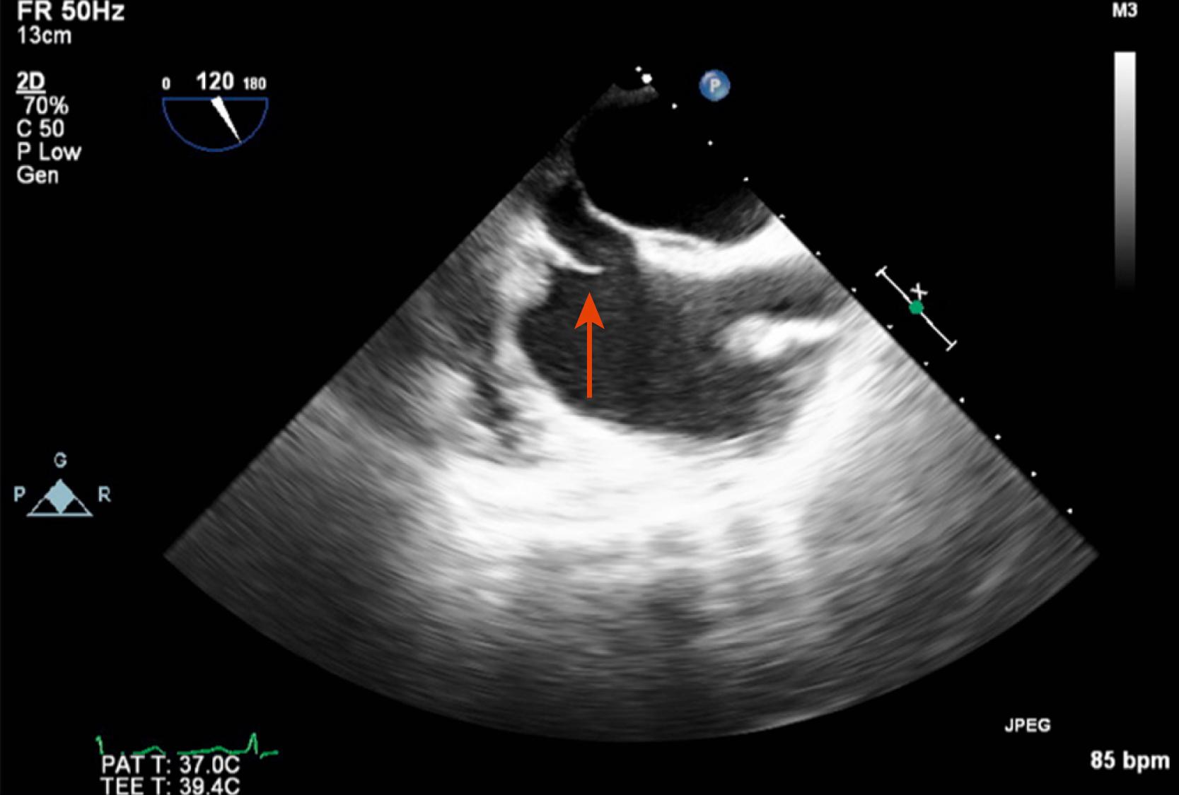 Figure 15.2, Midesophageal 122-degree view of a eustachian valve (red arrow) misdiagnosed as an atrial intracardiac lesion. (Also see Video 15.2 .)