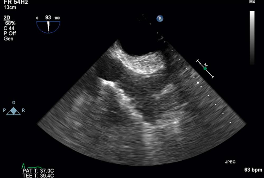 Figure 15.3, Midesophageal 93-degree view of lipomatous hypertrophy of the atrial septum. (Also see Video 15.3 .)