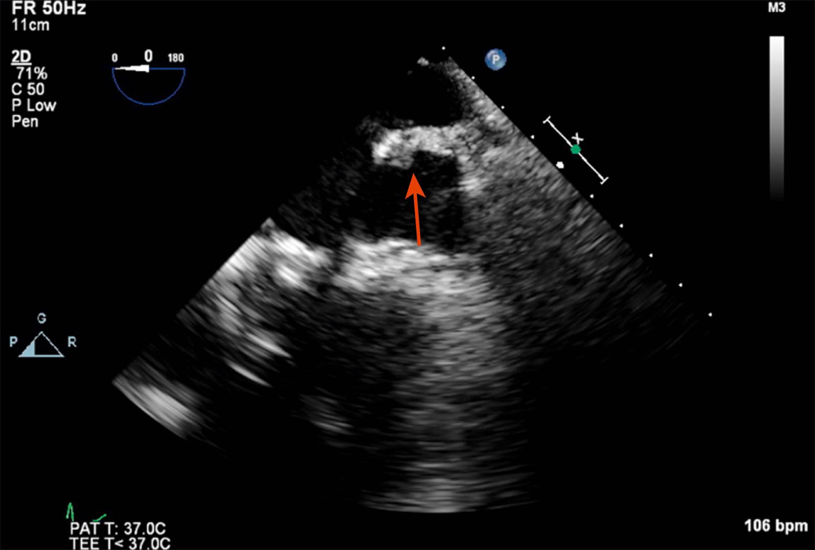 Figure 15.4, Midesophageal 0-degree view of a Coumadin ridge (red arrow) mimicking an intracardiac lesion. (Also see Video 15.4 .)