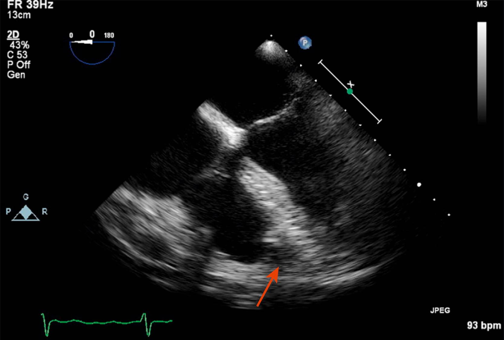 Figure 15.5, Midesophageal 0-degree view of a moderator band (red arrow) located in the right ventricular apex. (Also see Video 15.5 .)