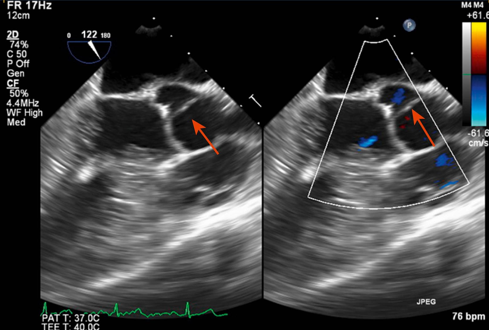 Figure 15.6, Midesophageal 122-degree view of Lambl excrescences (red arrow) misinterpreted as an aortic valve vegetation. (Also see Video 15.6 .)