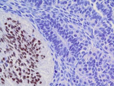 Figure 44.1, Fetal pituitary gland at 12 weeks' intrauterine gestational age shows TTF1 immunoreactive nuclei already identifiable in the posterior gland (at left) but not in the anterior gland (at right) .