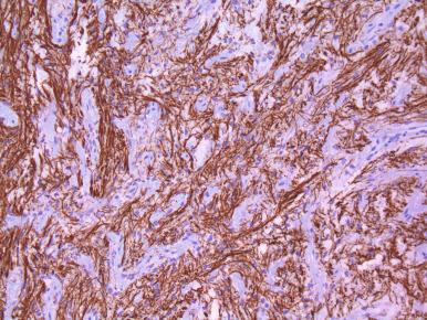 Figure 44.11, Normal posterior gland contains abundant axons, highlighted here by neurofilament immunohistochemistry; this can occasionally be very helpful in distinguishing normal posterior gland from spindle cell tumors such as schwannoma or meningioma that occasionally frequent the sellar region.