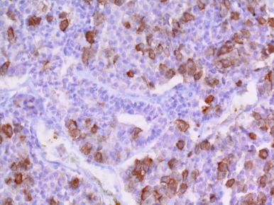 Figure 44.12, Pituitary blastoma is a very rare infantile pituitary tumor that is associated with DICER1 mutation and is almost inevitably IHC(+) for ACTH, as in this example.