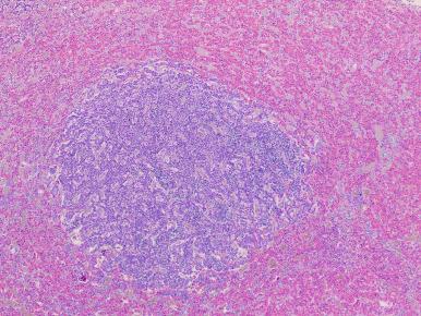 Figure 44.13, Incidental pituitary adenomas are a frequent finding not only on premortem neuroimaging studies but at the time of autopsy; this one was a prolactinoma.