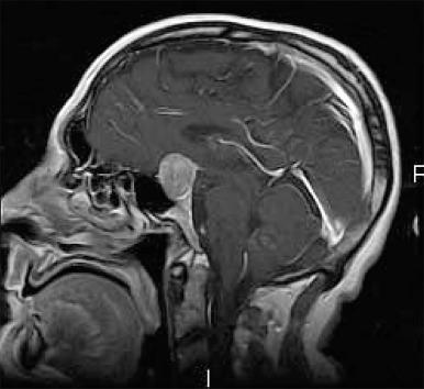 Figure 44.14, Pituitary adenomas more than 1 cm in greatest dimension are termed macroadenomas; compare with the sagittal MRI shown of normal gland in Fig. 44.5 .