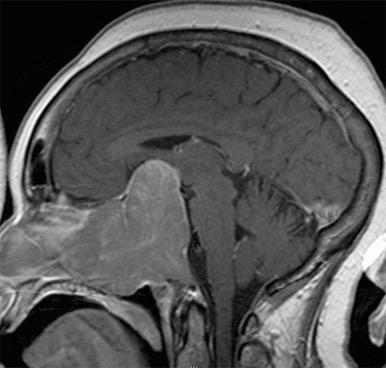 Figure 44.15, Giant pituitary adenomas, defined as greater than 4 cm, sometimes extend into the nasopharyngeal space, mimicking a nasopharyngeal carcinoma.