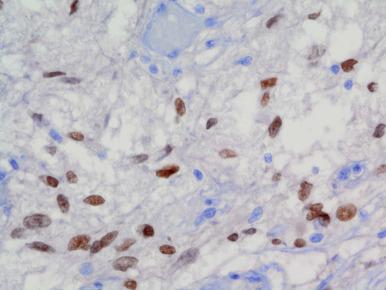 Figure 44.2, Adult posterior pituitary gland with nuclear TTF1 immunoreactivity; TTF1 IHC does not distinguish between normal posterior gland and TTF1 IHC(+) sellar region tumors, such as pituicytoma, spindle cell oncocytoma, and granular cell tumor of the neurohypophysis.