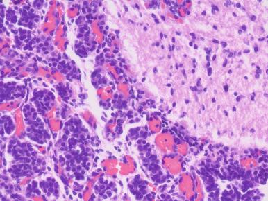 Figure 44.3, Fetal pituitary gland at 22 weeks' intrauterine gestation shows clear distinction between fibrillary posterior (upper right) and highly vascular epithelial anterior (lower left) portions of the gland.