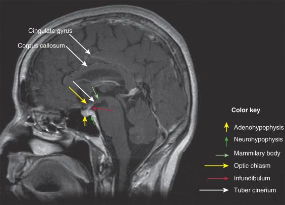 Figure 44.5, Sagittal magnetic resonance imaging (MRI) scan shows normal adult anterior and posterior pituitary and sellar region anatomy. The posterior pituitary “bright spot” is a normal MRI finding, referring to the intrinsically high T1 signal in the posterior pituitary attributed to the storage of vasopressin.