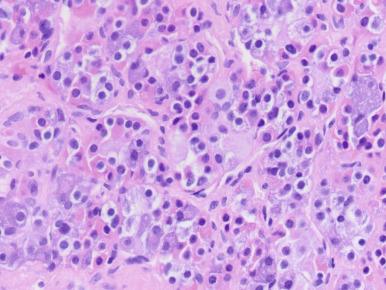 Figure 44.8, Normal anterior pituitary gland shows an assortment of cell types on H&E arranged in clusters known as acini; the different cell types vary in numbers between the lateral wings, where more GH and PRL cells are located, versus the median wedge where more ACTH cells are found.