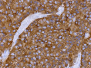 Figure 44.10, All pituitary adenomas, regardless of cell type, are diffusely immunoreactive for synaptophysin; blood vessels show lack of immunostaining in this image.