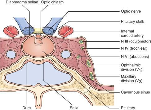 Figure 44.1, Anatomic relationships of the pituitary gland. A coronal section through the sella turcica shows the pituitary gland in relation to surrounding structures: the cavernous sinuses, carotid arteries, and cranial nerves II, III, IV, V 1 , V 2 , and VI.