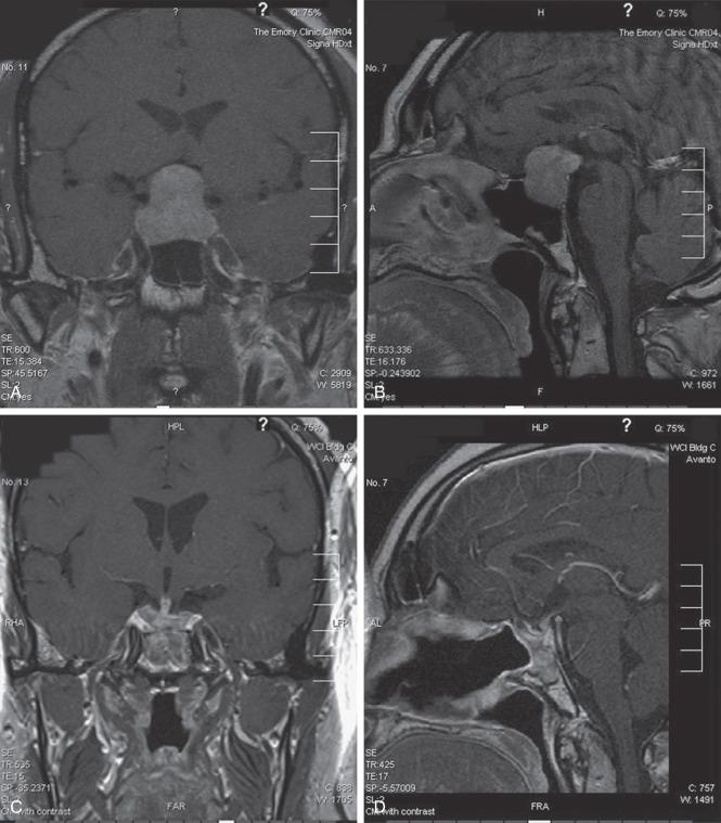 Figure 44.5, Magnetic resonance imaging (MRI) of a pituitary tumor. Coronal (A) and sagittal (B) MRI scans with contrast agent demonstrating a clinically nonfunctioning pituitary macroadenoma prior to treatment. Coronal (C) and sagittal (D) MRI scans with contrast material of the same patient after surgical resection via a transsphenoidal approach.