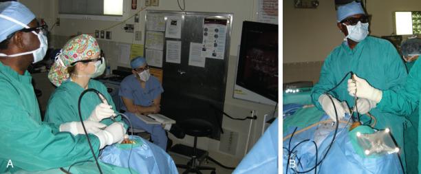 Figure 44.7, Using the three-dimensional (3D) endoscope. (A) The surgeon should use a “three-handed” technique. An assistant drives the endoscope in one naris, while the primary surgeon uses an instrument in each naris. The 3D endoscope, such as the Visionsense, seen here, provides a more realistic view of the anatomy than does the earlier two-dimensional endoscope. (B) Three-dimensional glasses are required.