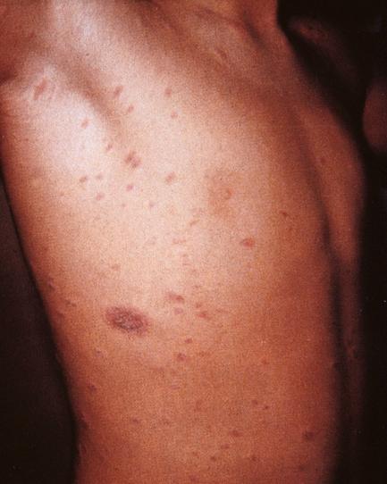 Fig. 177.2, Pityriasis rosea with herald patch and subtle smaller spots on trunk.