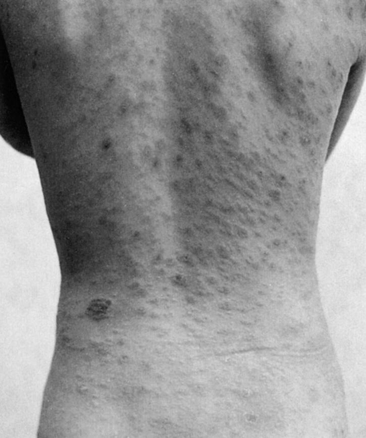 Fig. 177.3, Typical “Christmas tree” pattern of pityriasis rosea.