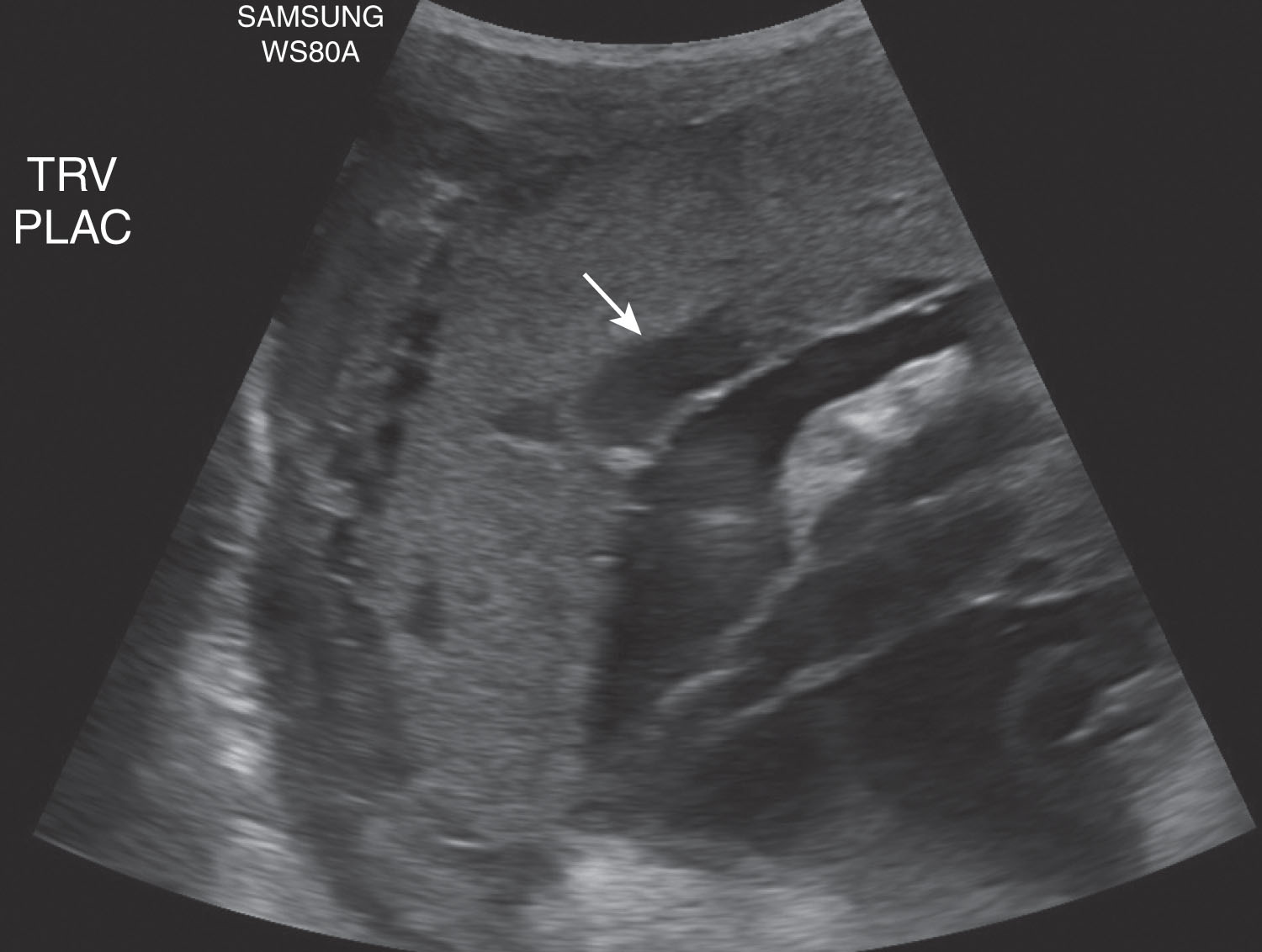 Fig. 56.11, Placental lake seen within this anterior right sidewall placenta at 20 weeks of gestation. Blood flow was visualized under real-time imaging (arrow) .