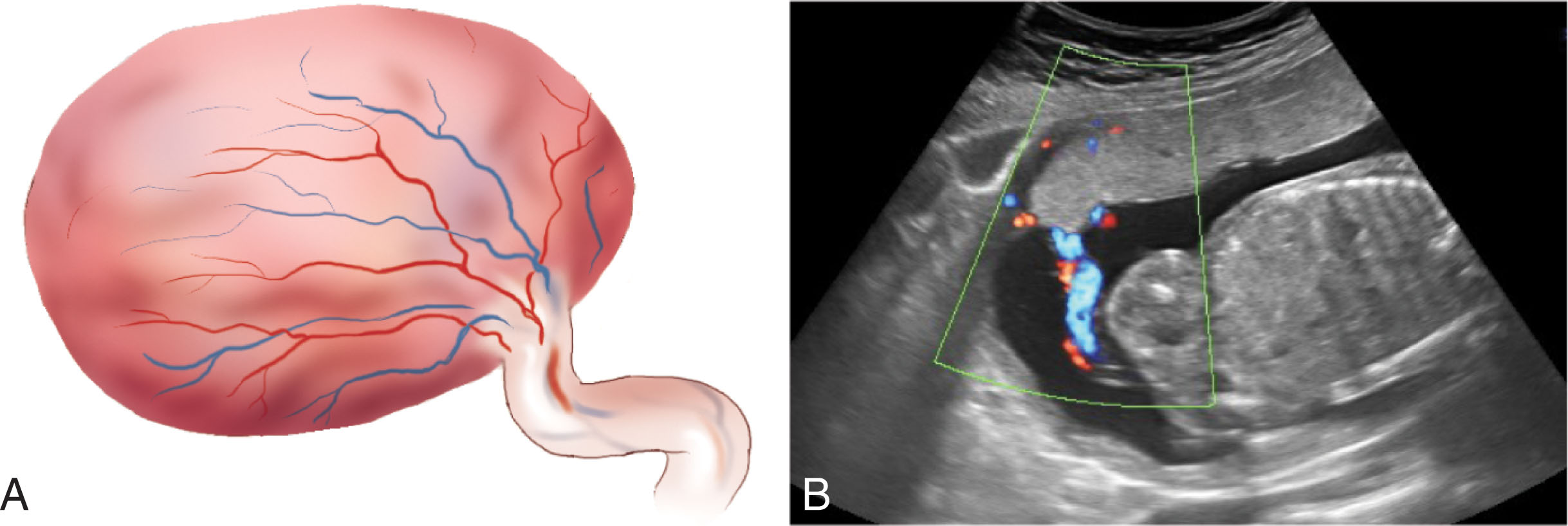 Fig. 56.3, (A) A battledore placenta refers to the insertion of the umbilical cord at the margin of the placenta. (B) This sagittal transabdominal image reveals a marginal cord insertion.