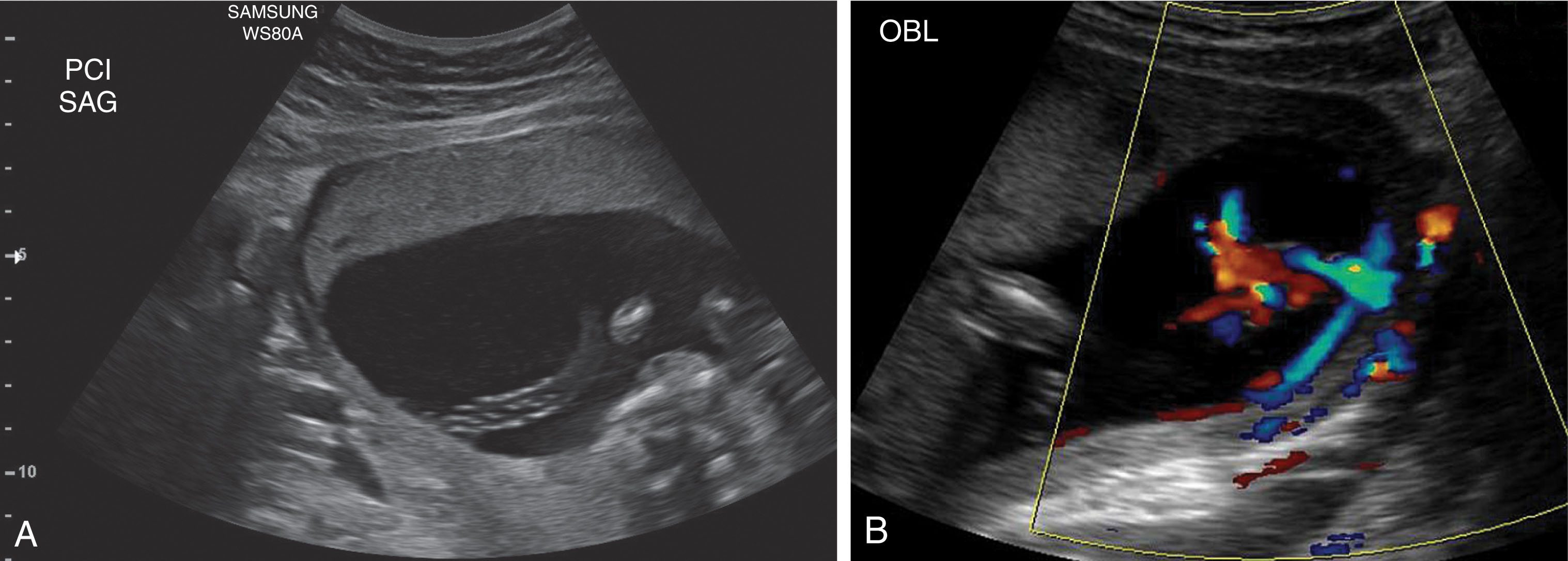 Fig. 56.4, Velamentous insertions.