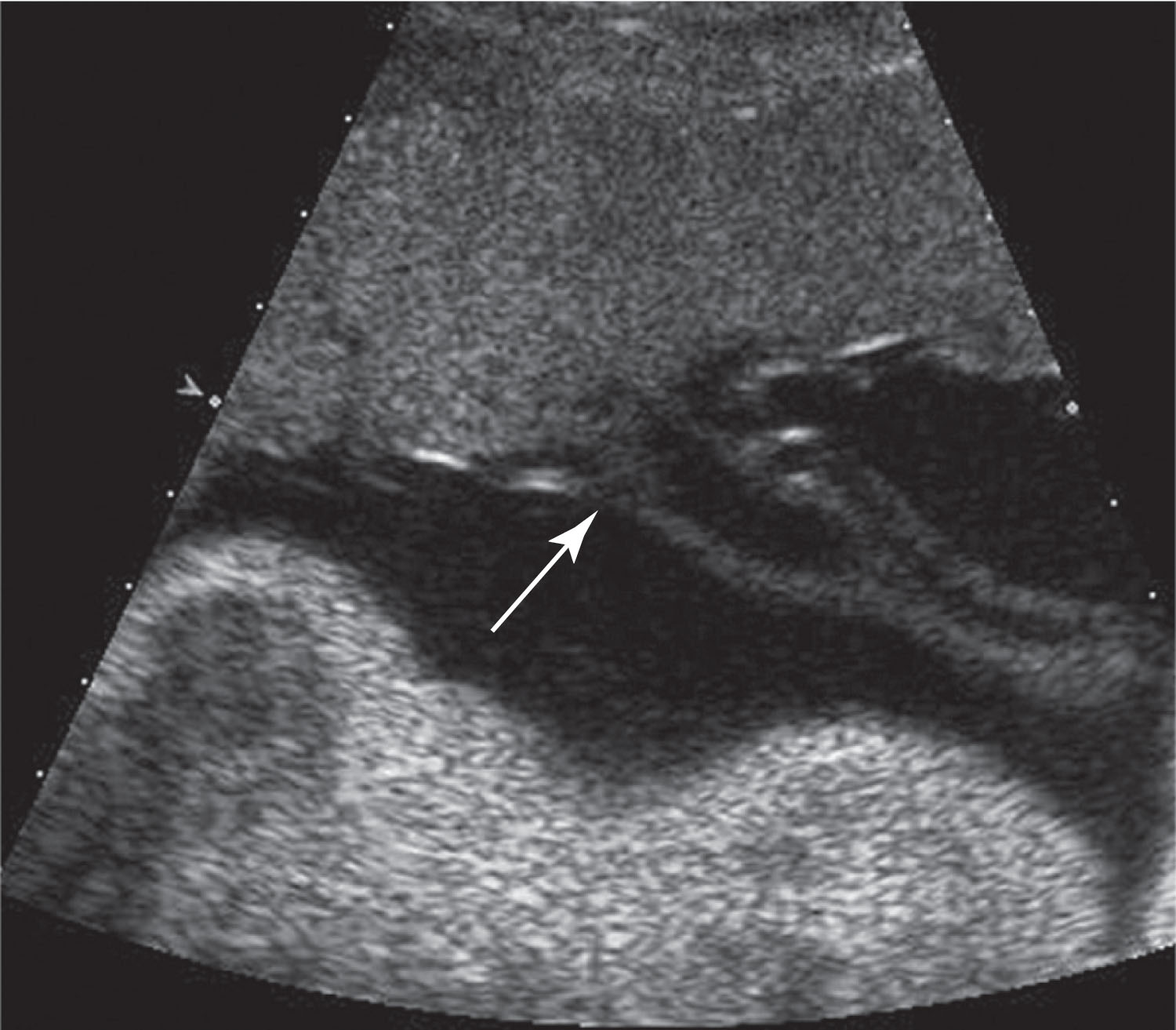 Fig. 56.5, Umbilical cord is seen at placental insertion site (arrow) .