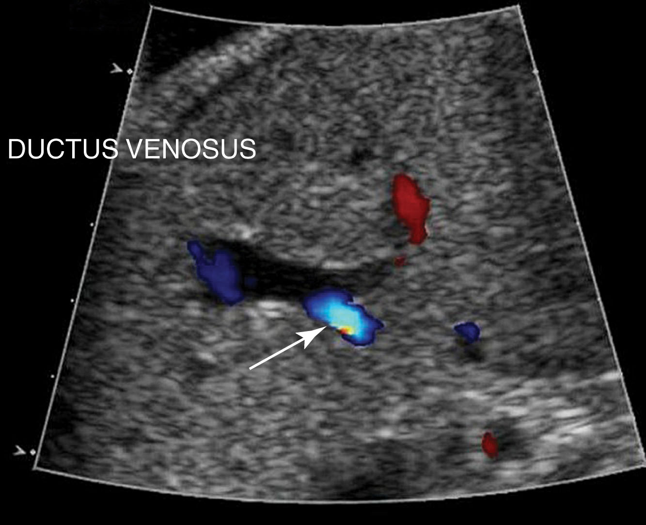 Fig. 56.7, Axial view of fetal abdomen identifies the ductus venosus (arrow) as it branches off the umbilical vein.